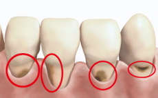 歯の根元を守る予防習慣