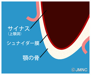 インプラント治療：歯肉剥離イラスト