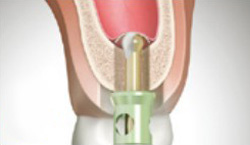 インプラント治療：上顎動の粘膜を持ち上げるイメージ