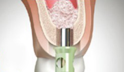 インプラント治療：人工骨を入れるイメージ